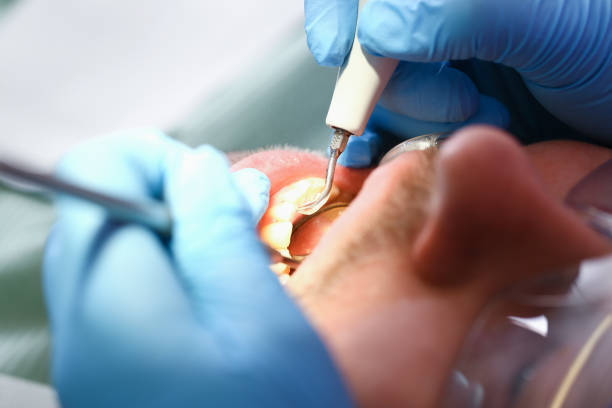 Best Emergency Wisdom Teeth Removal in Serenada, TX
