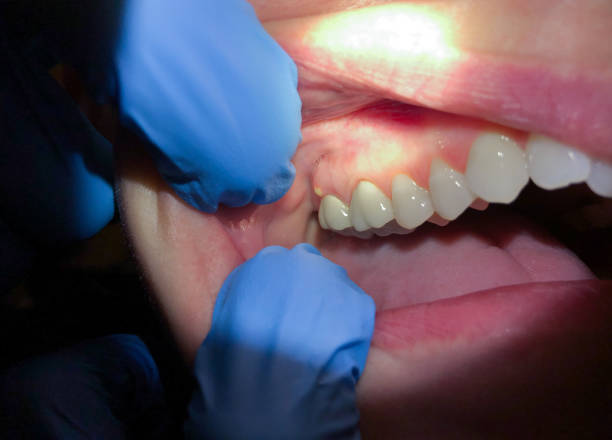 Best Emergency Treatment for Dental Infections or Abscesses in Serenada, TX
