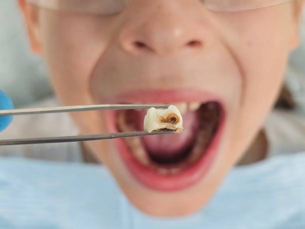 Best Emergency Tooth Extraction in Serenada, TX