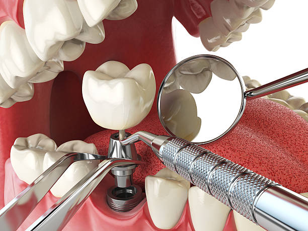 Best Emergency Tooth Extraction in Serenada, TX